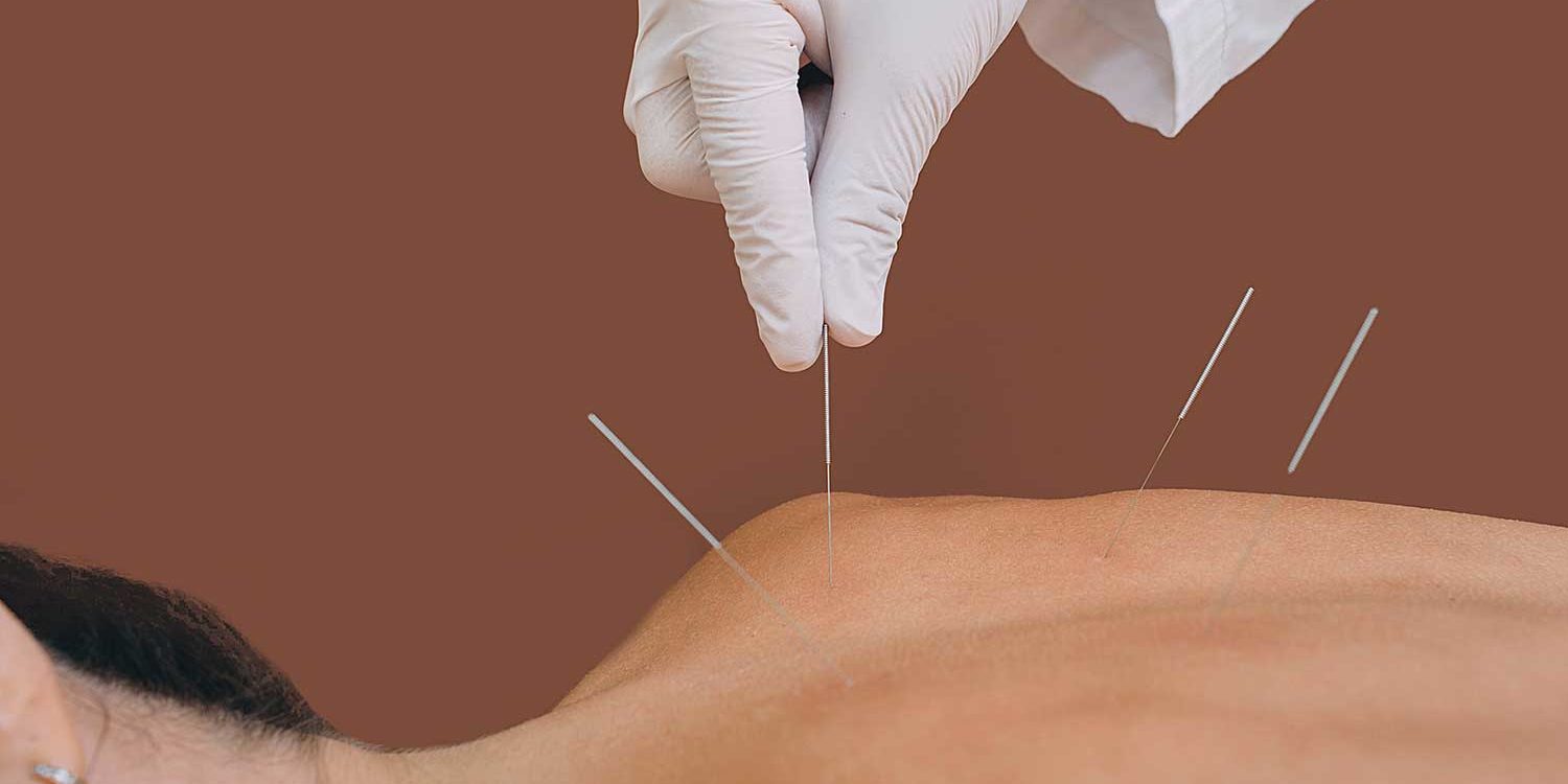 Acupuncture Pain Relief Without Painkillers