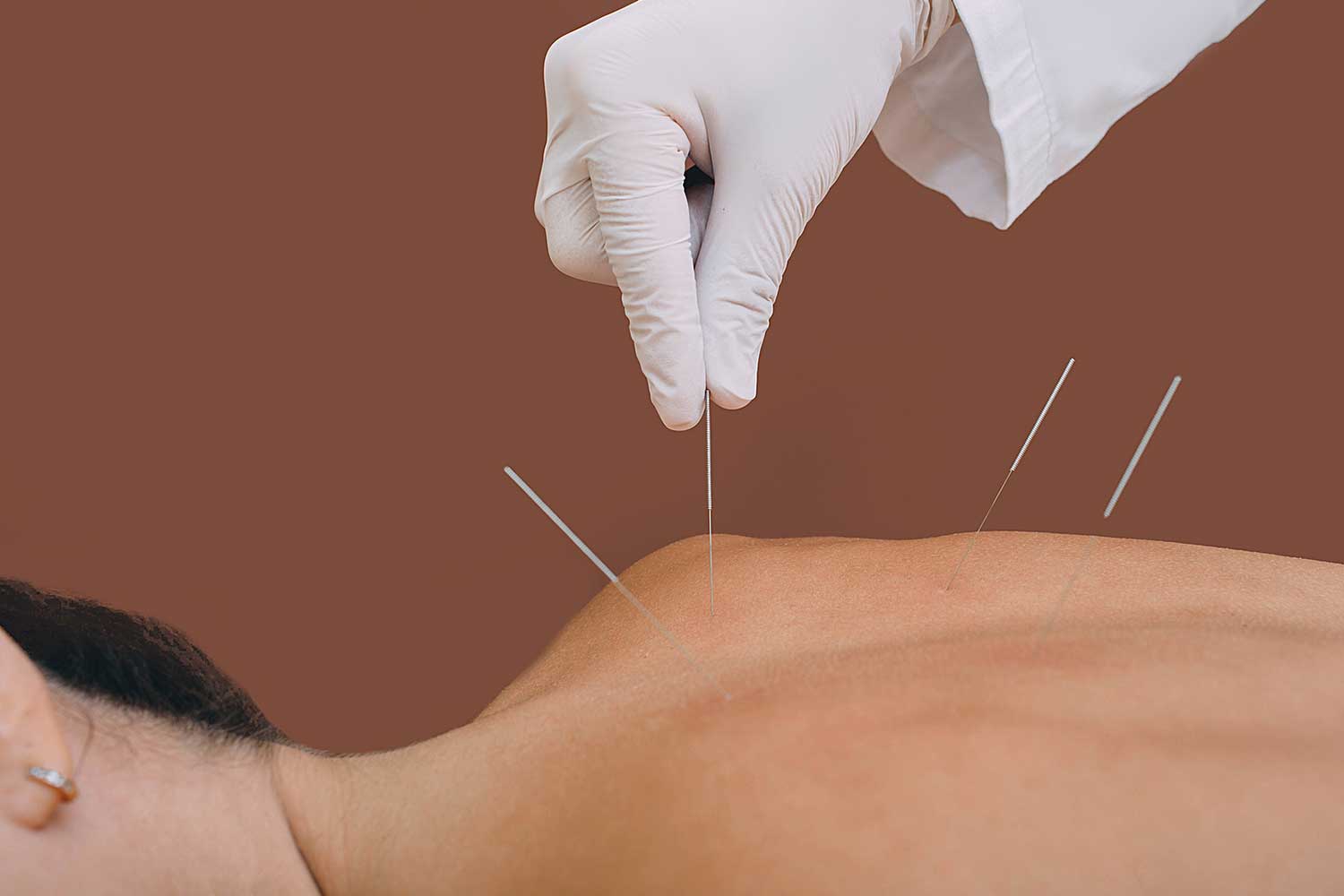 Acupuncture Pain Relief Without Painkillers