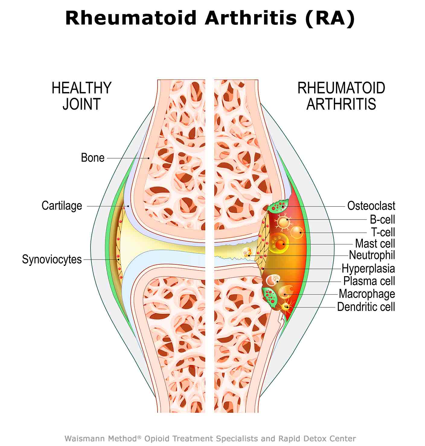 Rheumatoid Arthritis